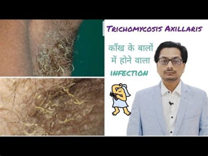 trichobacteriosis axillaris
